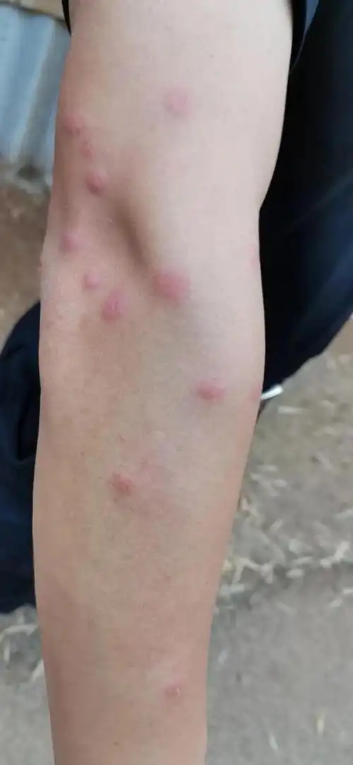 每一个被蚊虫叮咬的脓包,都是戍边民警身上的勋章