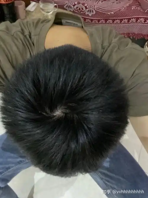 什么样子的发旋是正常的啊