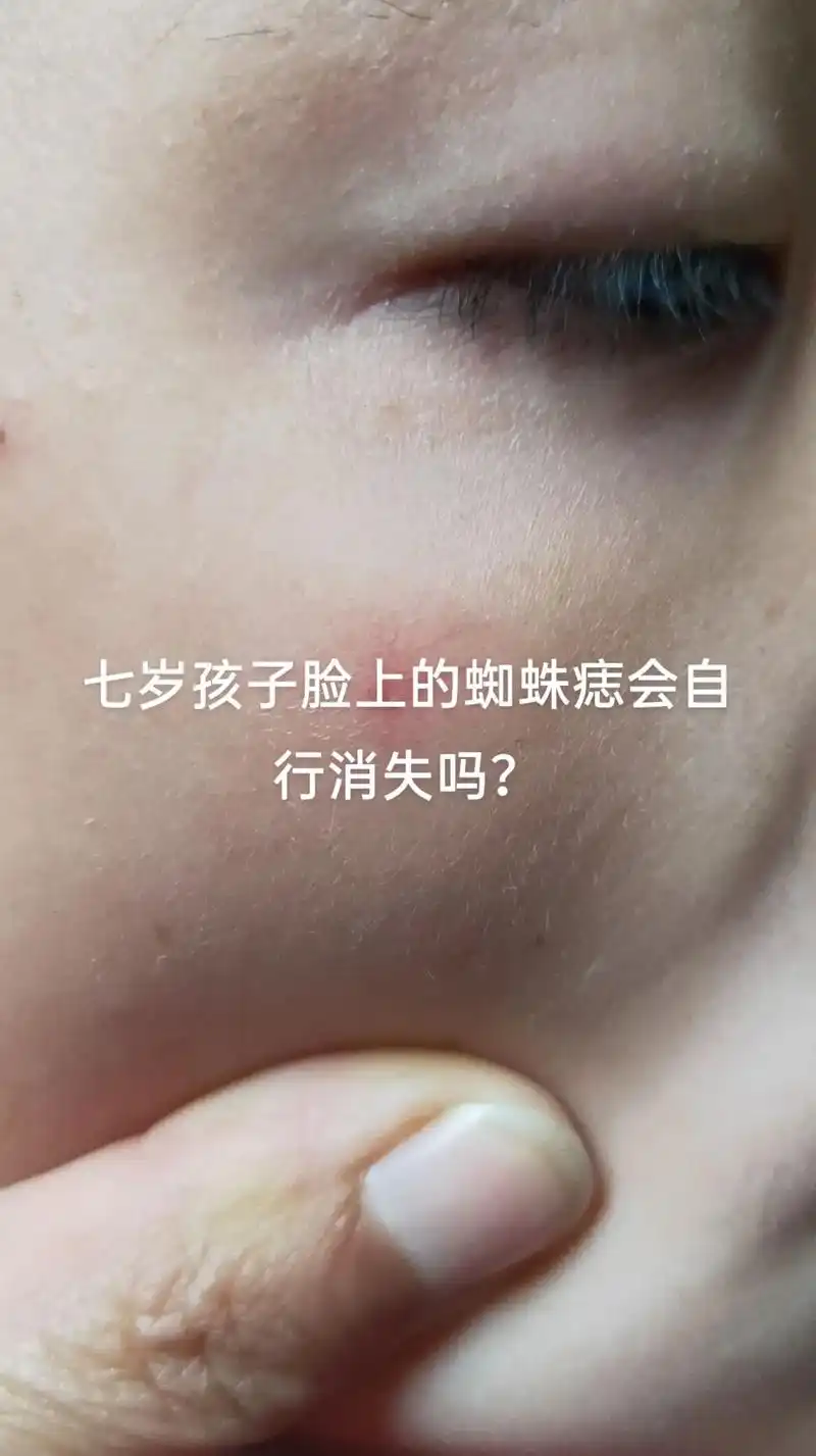 7岁孩子脸上的蜘蛛痣会自行消失吗?
