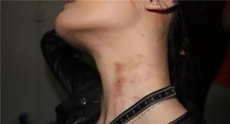 脖子被男友"种草莓",隔天就身亡,怎么回事?