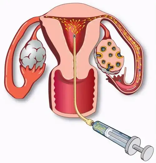仁爱!做人工受孕前需要做哪些检查"一元复始"-第2张图片-宠宝网