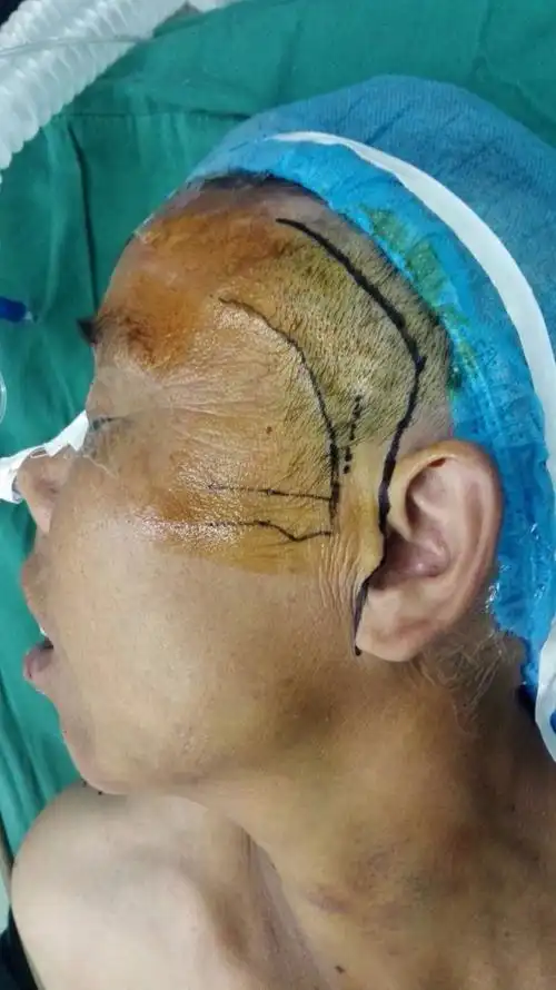 颞下颌关节手术