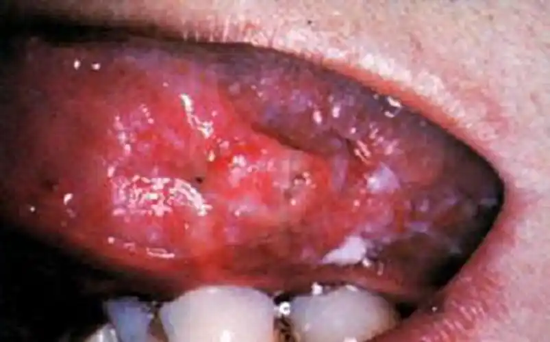吃摈榔的口腔癌的图片