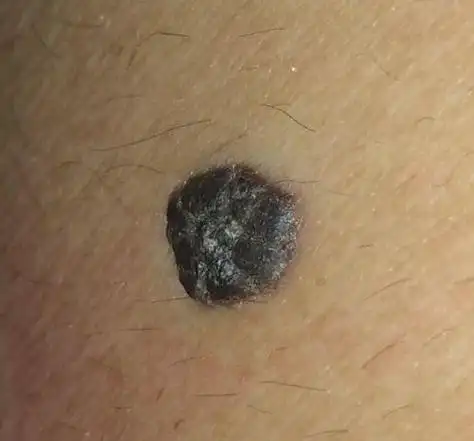 身上长痣很正常,但若出现了这几种痣,就要引起注意,提前了解下