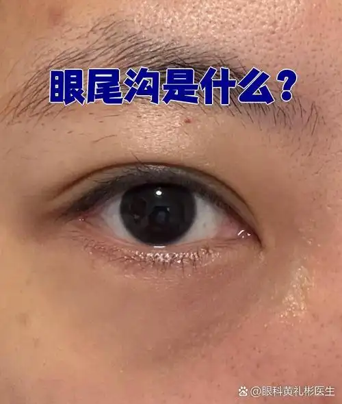眼尾沟是指下眼睑靠近鼻侧的一条凹陷纹路,通常出现在卧蚕下方