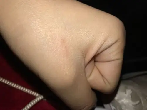 被50多天狗抓破点表皮当时没感觉都不知道抓我了没出血晚上洗脸腌疼才