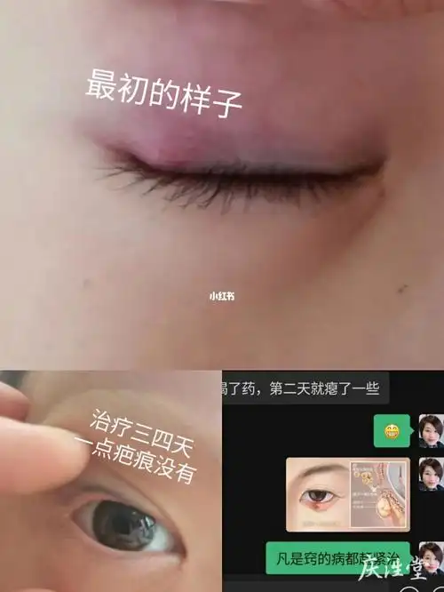 麦粒肿两个小朋友的对比治疗