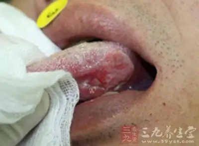 舌癌相对来说成病时间较长