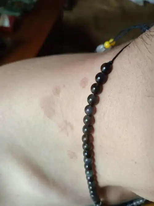 参与团队:生活解答 向ta提问私信ta  展开全部 花斑糠疹,旧称花斑癣