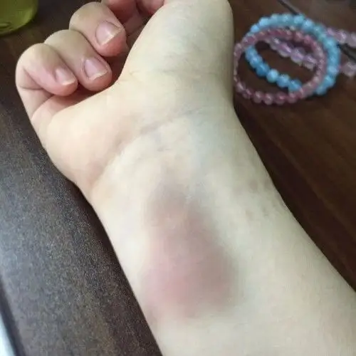 右手手腕今早突然发现有淤青