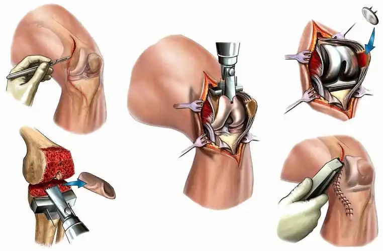慈海医疗||手足外,骨科成功开展首例人工膝关节置换术-医疗动态-山东