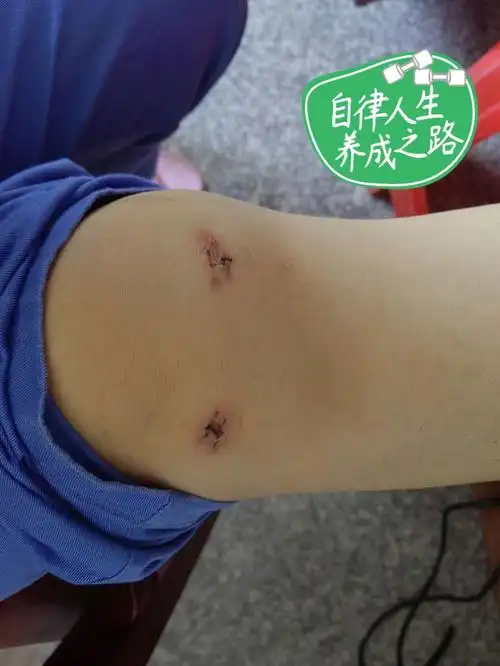 关节镜术后2周拆线啦开心记录一下