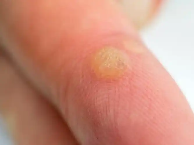 阅读更多疣是因"人类乳头瘤病毒"(hpv)感染而产生的良性皮肤增生,可