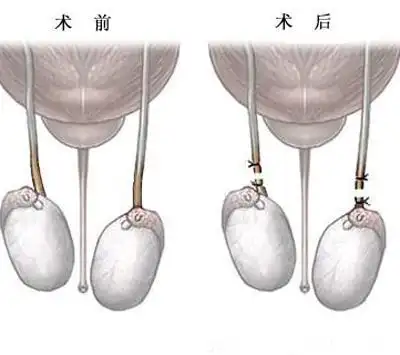 男子结扎四个月后妻子怀孕不得已进行流产,手术医院被投诉