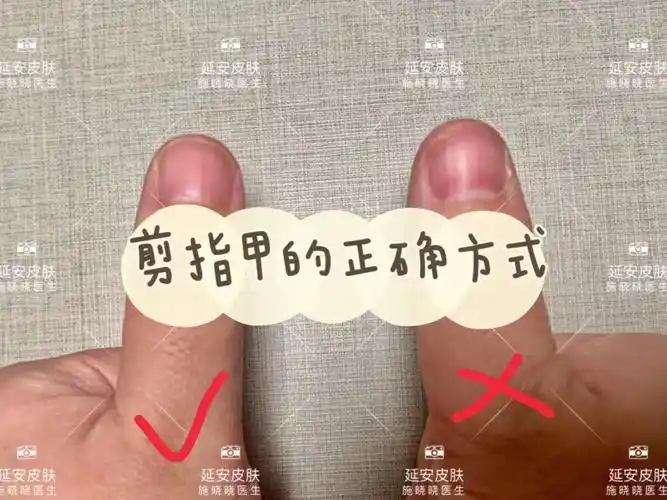 甲沟炎正常指甲的正确修剪方式