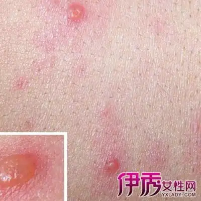 【图】登革热症状红疹图片展示 东南亚地区儿童死亡的主要祸首