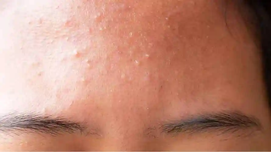 闭口粉刺是什么白头粉刺挤出来是什么