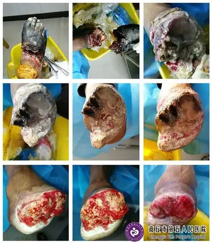 我父亲糖尿病足,61岁,不想截肢,怎么能治