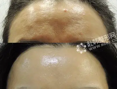 玻尿酸丰额头前后对比  图片来自 德奥琳整形外科