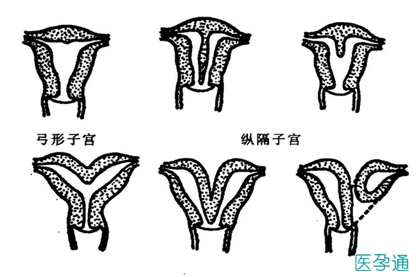 女性弓形子宫能做试管婴儿吗可以但要先治疗