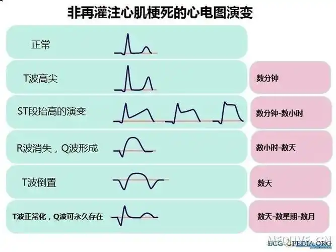 图非再灌注心肌梗死的心电图演变