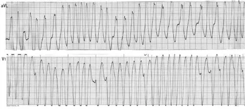 临床特点及处理61心脏性猝死的发生率1.5%~2.