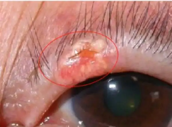 肿块形成溃疡及肿块主要的临床表现为:早期很少有自觉症状,局部表现为