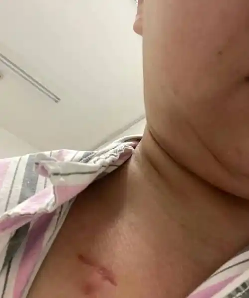 33岁女,未分娩前确诊乳腺癌,十次化疗,一次全切,记录抗癌日记_因为