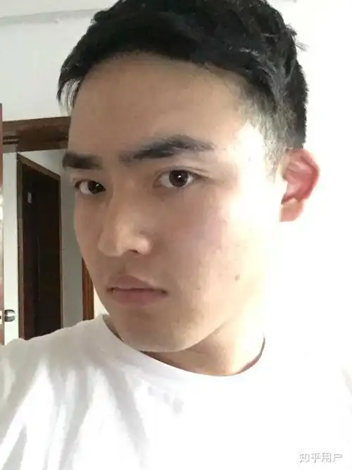 男生做双眼皮手术是什么体验?