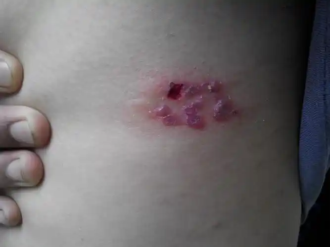 (皮肤)前天腋下起了几个小红点,三天后就烂了,这是怎么回事