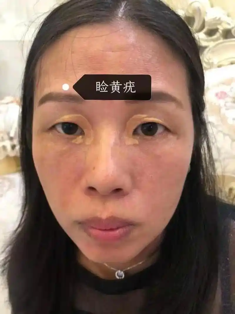 很多人问我睑黄疣是什么导致的, 他其实就是身体的一个系统发出 - 抖