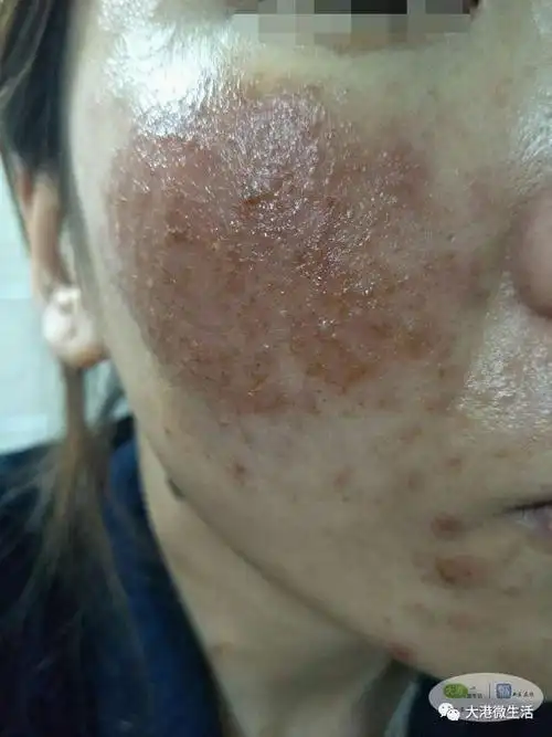 春天来了这个不容忽视大港一妹纸发帖害的我脸近毁容有图有真相