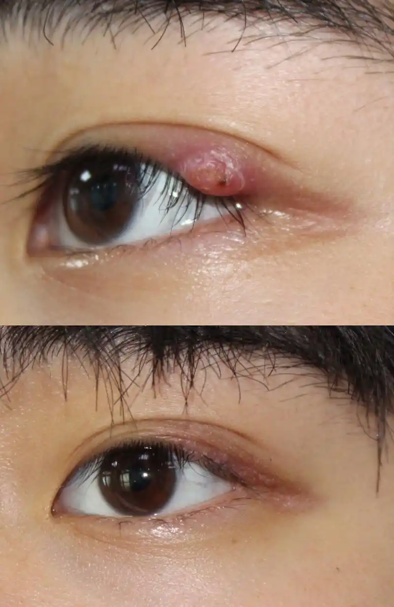 麦粒肿偏方中指根部绑根线2天就好,麦粒肿偏方