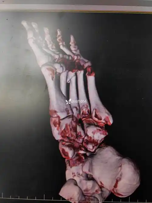 强烈要求保守治疗的gustilo  i型跖骨开放骨折,半年后仍不愈合