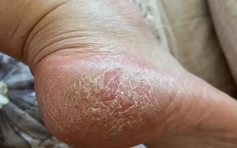 秋冬脚后跟干裂这么轻松就解决了!这个方法快拿去!