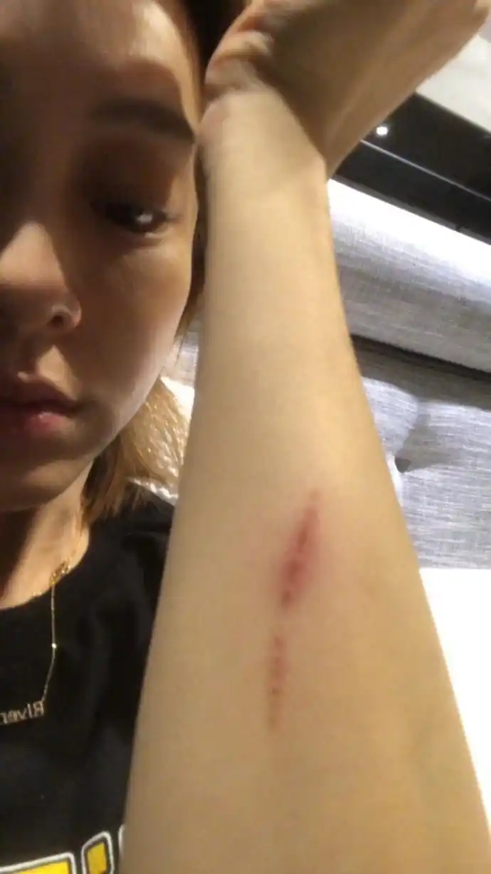 组图:范玮琪意外摔倒膝盖受伤 红肿淤青伤势不轻