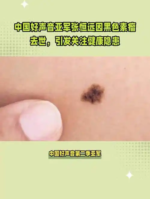中国好声音亚军张恒远因黑色素瘤去世,引发关注健康隐患-度小视