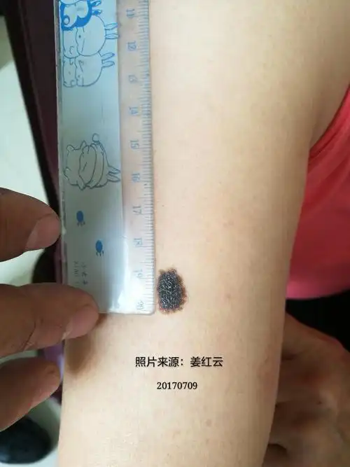 什么样的色素痣需要切除哪? - 好大夫在线