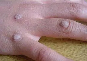 手上长瘊子是什么原因引起的