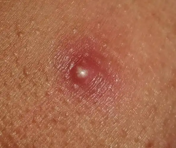 这是个什么痘痘?