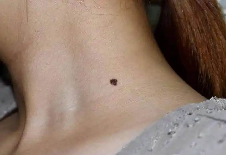 提醒:长在9个部位的痣,与癌症"密不可分",是时候了解了