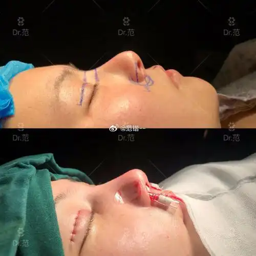 往往顾忌不到,露孔问题比较严重,分享部分我鼻翼缘后缩矫正案例不植皮