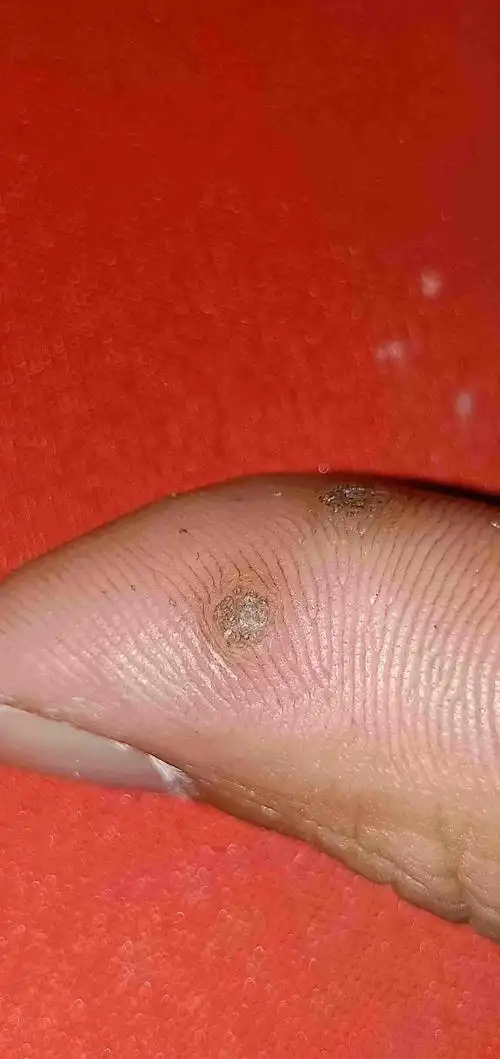 透明疣手掌,手掌透明寻常疣-图片大观-奇异网