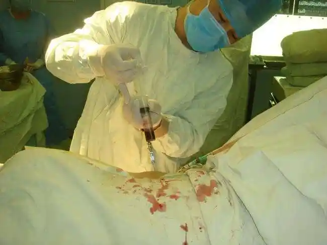 早期股骨头坏死治疗新方法——钽棒 自体骨髓移植