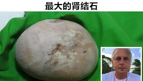 4,最大的肾结石由于生活条件越来越好,胖子人群比例也在逐年增加,那么