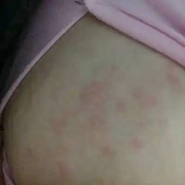 哺乳期三个月胸部乳房长满红红痒痒的疮,请问可以搽什麼啊?