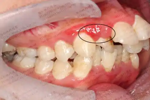 牙龈发炎就是上火?