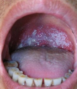 口腔炎的症状是什么?