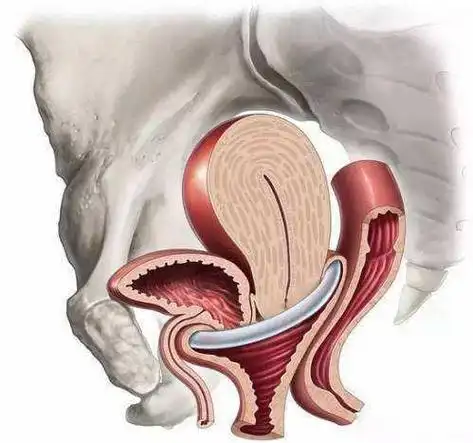 直肠相邻,因此子宫脱垂还可同时伴有膀胱尿道和直肠膨出
