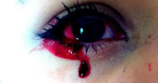 17岁少女得神秘怪病每天七窍流血半小时